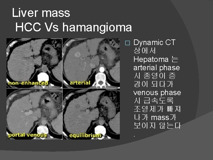 Liver mass HCC Vs hamangioma � Dynamic CT 상에서 Hepatoma 는 arterial phase 시