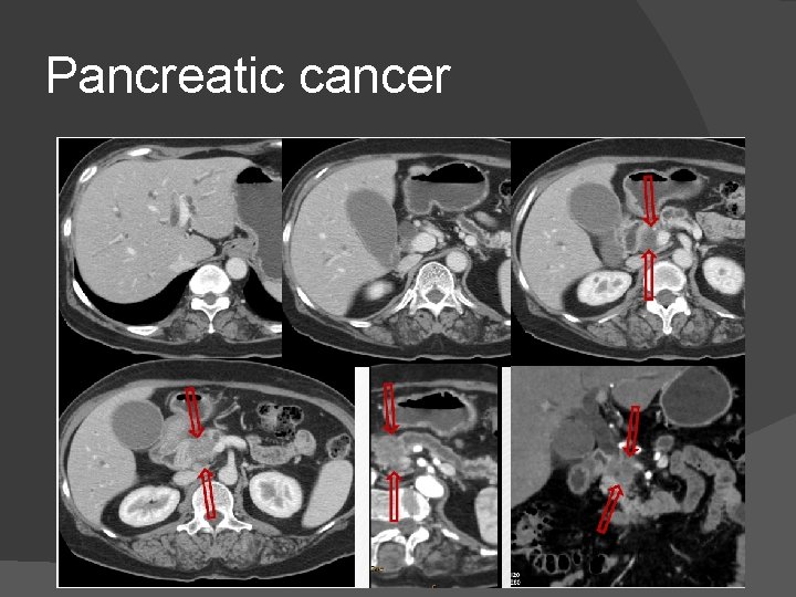 Pancreatic cancer 