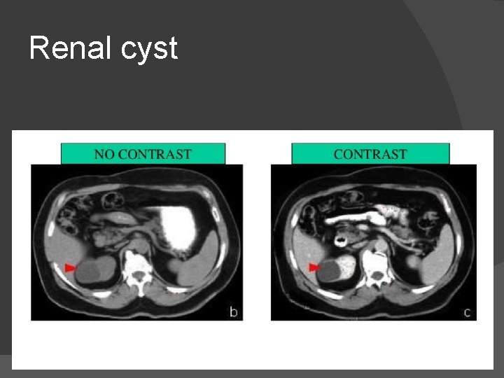 Renal cyst 