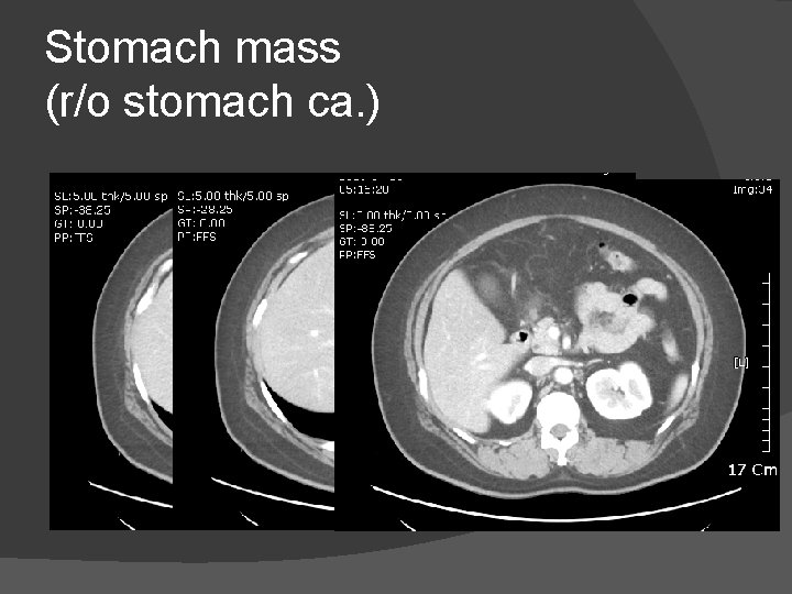 Stomach mass (r/o stomach ca. ) 