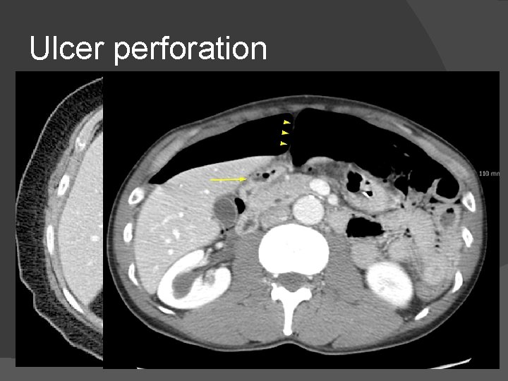 Ulcer perforation 