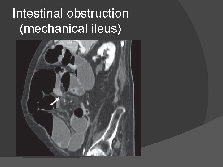 Intestinal obstruction (mechanical ileus) 