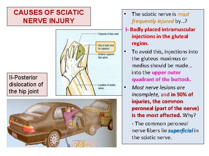 CAUSES OF SCIATIC NERVE INJURY II-Posterior dislocation of the hip joint • The sciatic