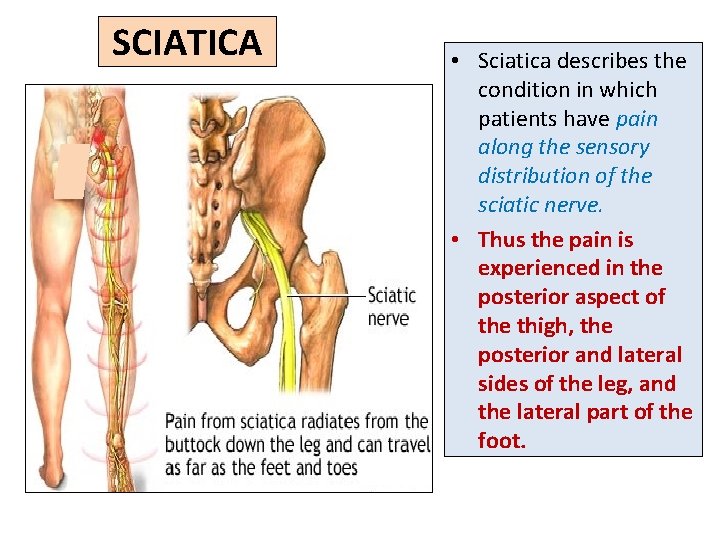 SCIATICA • Sciatica describes the condition in which patients have pain along the sensory