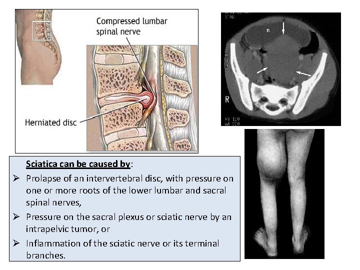 Sciatica can be caused by: Ø Prolapse of an intervertebral disc, with pressure on