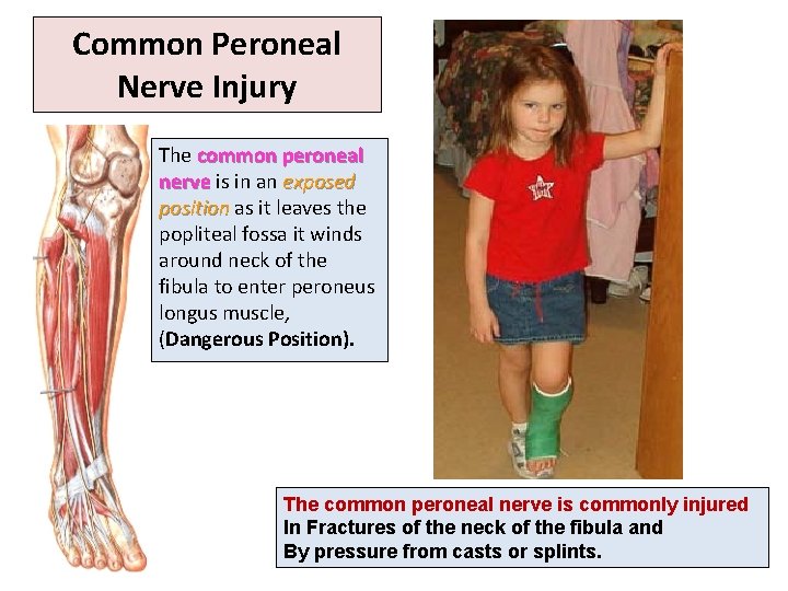 Common Peroneal Nerve Injury The common peroneal nerve is in an exposed position as
