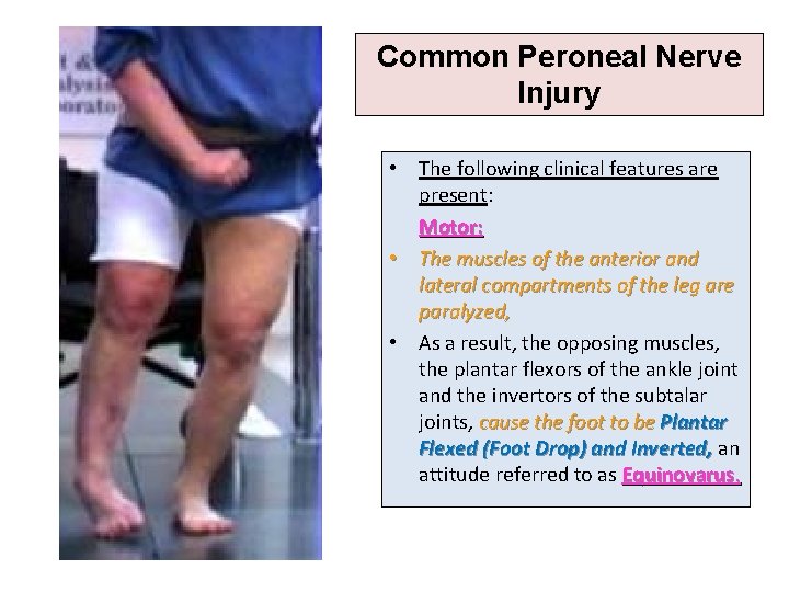 Common Peroneal Nerve Injury • The following clinical features are present: Motor: • The