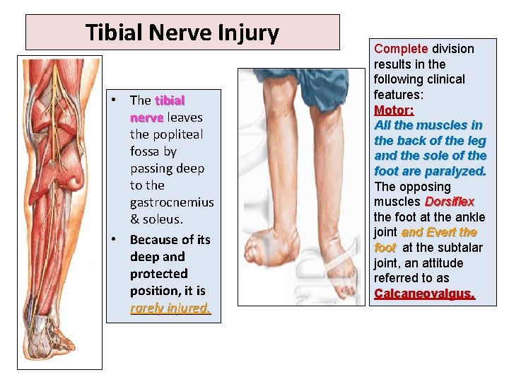 Tibial Nerve Injury • The tibial nerve leaves the popliteal fossa by passing deep