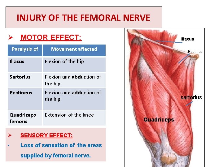 INJURY OF THE FEMORAL NERVE Ø MOTOR EFFECT: Paralysis of Iliacus Movement affected Iliacus