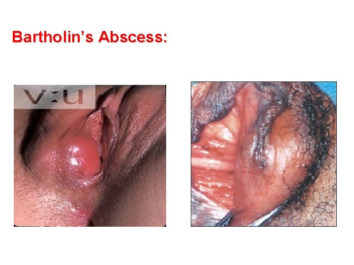 Bartholin’s Abscess: 