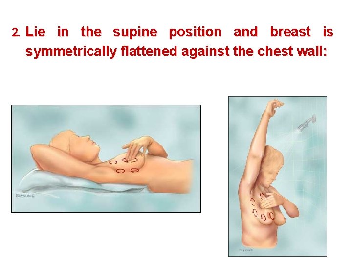 2. Lie in the supine position and breast is symmetrically flattened against the chest