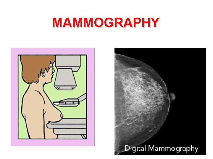 MAMMOGRAPHY 