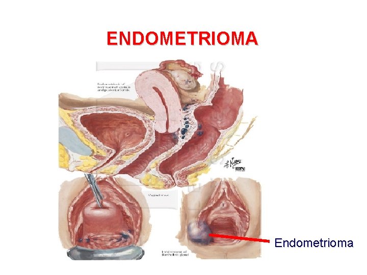 ENDOMETRIOMA Endometrioma 