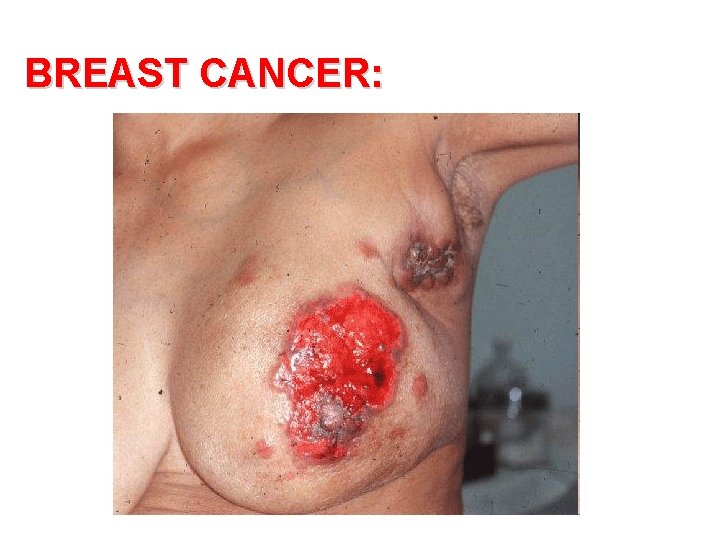 BREAST CANCER: 