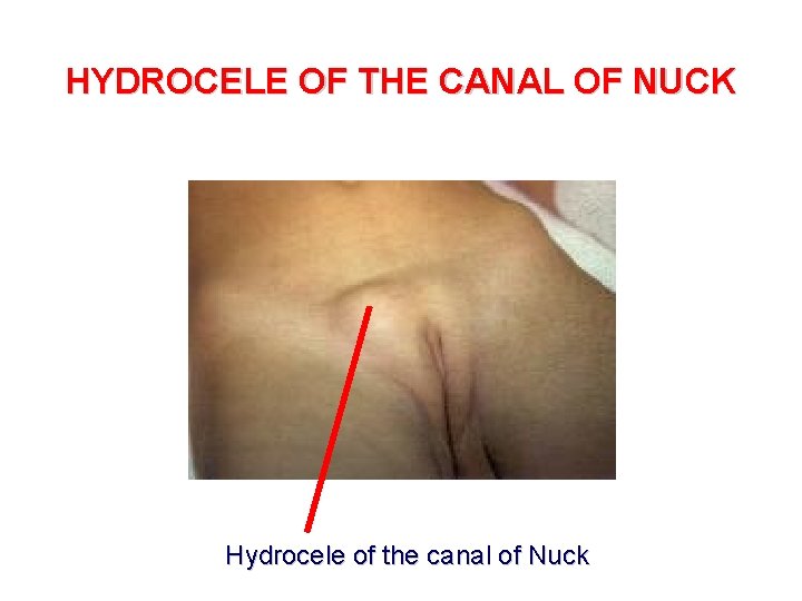 HYDROCELE OF THE CANAL OF NUCK Hydrocele of the canal of Nuck 