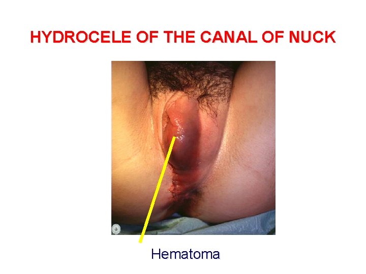 HYDROCELE OF THE CANAL OF NUCK Hematoma 