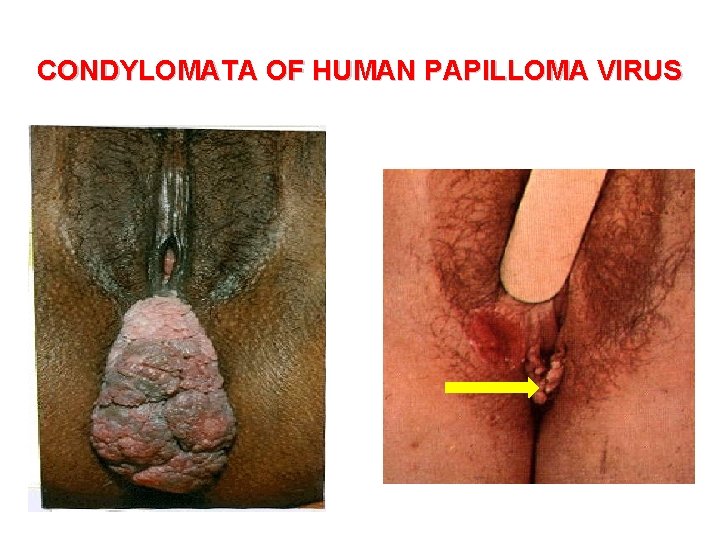 CONDYLOMATA OF HUMAN PAPILLOMA VIRUS 