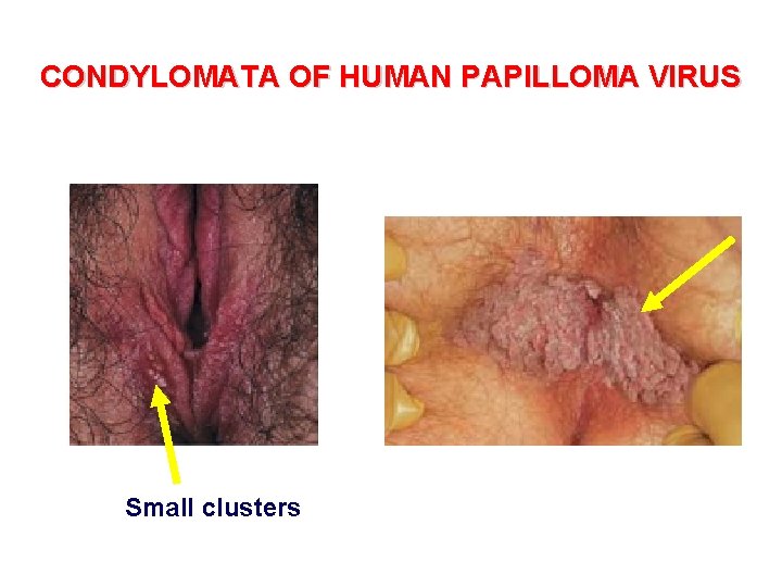 CONDYLOMATA OF HUMAN PAPILLOMA VIRUS Small clusters 