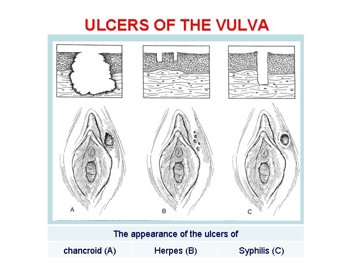 ULCERS OF THE VULVA The appearance of the ulcers of chancroid (A) Herpes (B)