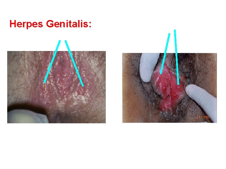 Herpes Genitalis: 