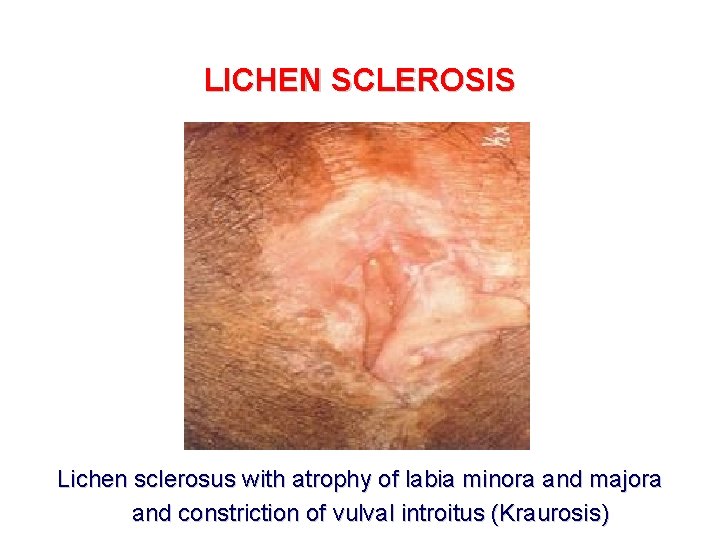 LICHEN SCLEROSIS Lichen sclerosus with atrophy of labia minora and majora and constriction of