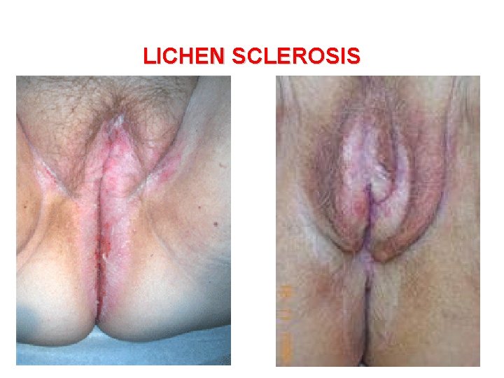 LICHEN SCLEROSIS 