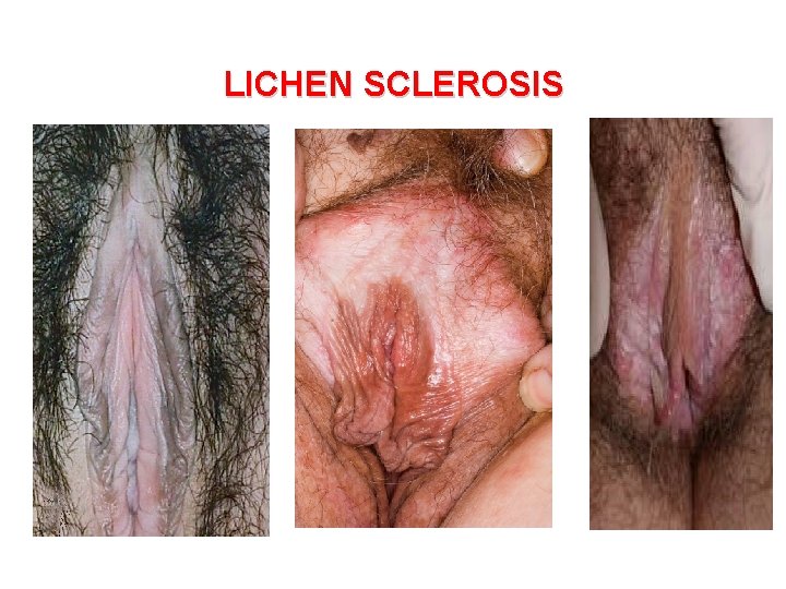 LICHEN SCLEROSIS 