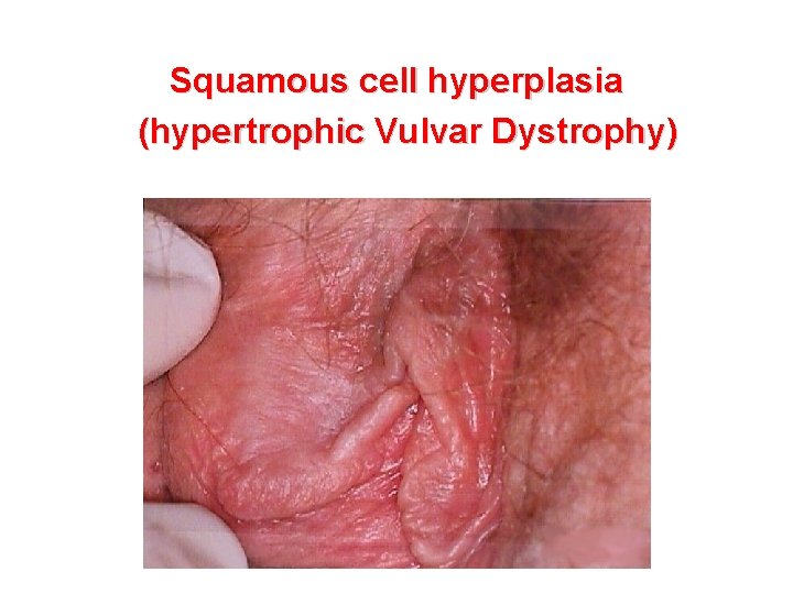 Squamous cell hyperplasia (hypertrophic Vulvar Dystrophy) 