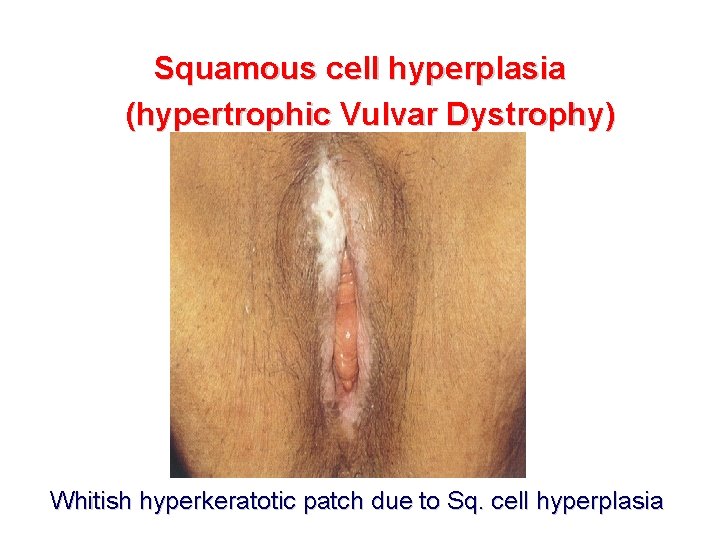 Squamous cell hyperplasia (hypertrophic Vulvar Dystrophy) Whitish hyperkeratotic patch due to Sq. cell hyperplasia
