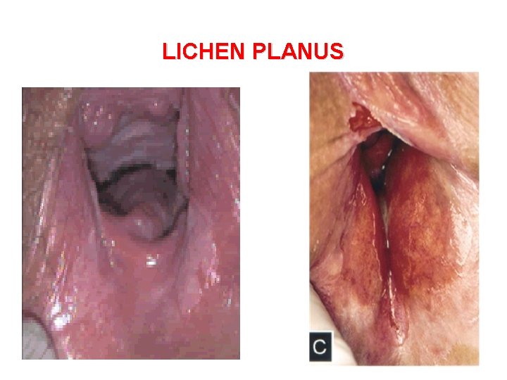 LICHEN PLANUS 