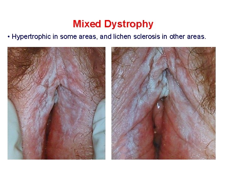 Mixed Dystrophy • Hypertrophic in some areas, and lichen sclerosis in other areas. 