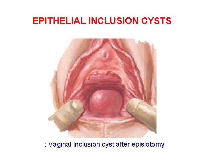 EPITHELIAL INCLUSION CYSTS : Vaginal inclusion cyst after episiotomy 