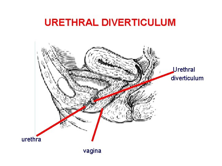 URETHRAL DIVERTICULUM Urethral diverticulum urethra vagina 