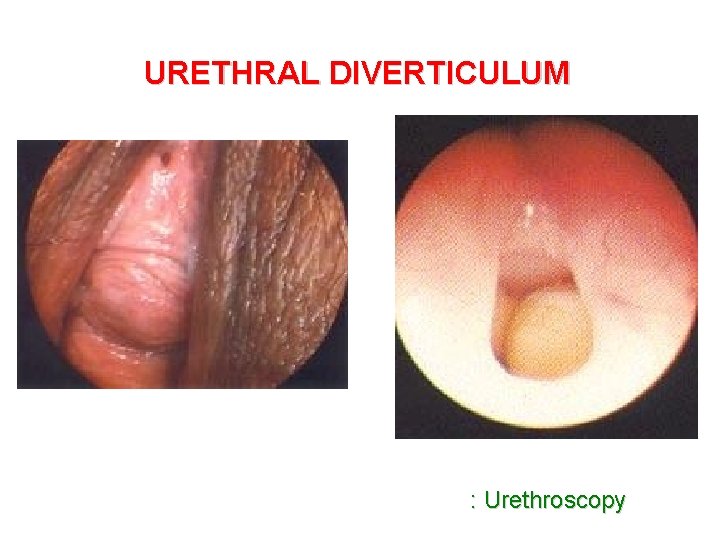 URETHRAL DIVERTICULUM : Urethroscopy 