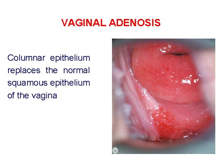 VAGINAL ADENOSIS Columnar epithelium replaces the normal squamous epithelium of the vagina 