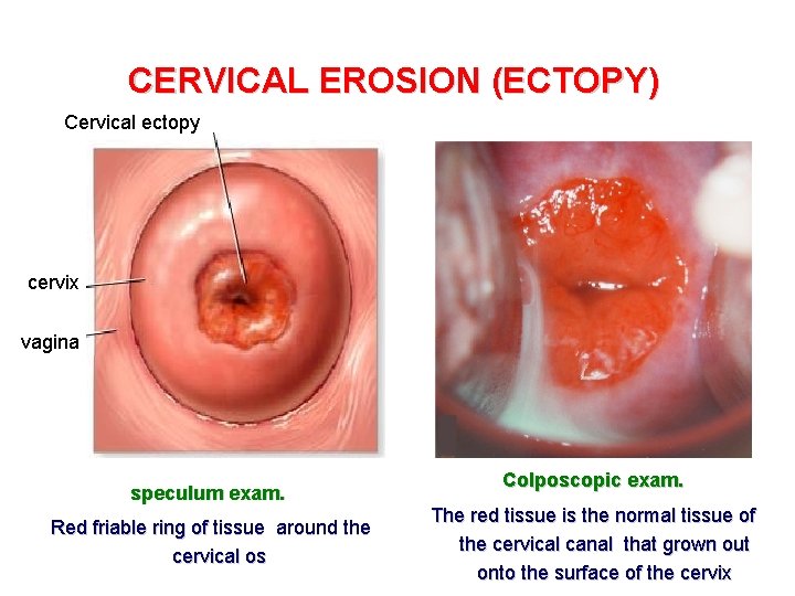CERVICAL EROSION (ECTOPY) Cervical ectopy cervix vagina speculum exam. Red friable ring of tissue