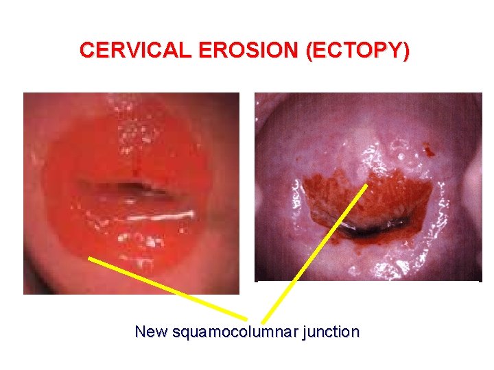 CERVICAL EROSION (ECTOPY) New squamocolumnar junction 
