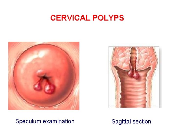 CERVICAL POLYPS Speculum examination Sagittal section 