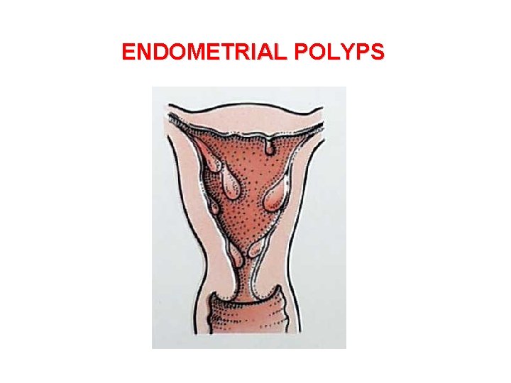 ENDOMETRIAL POLYPS 