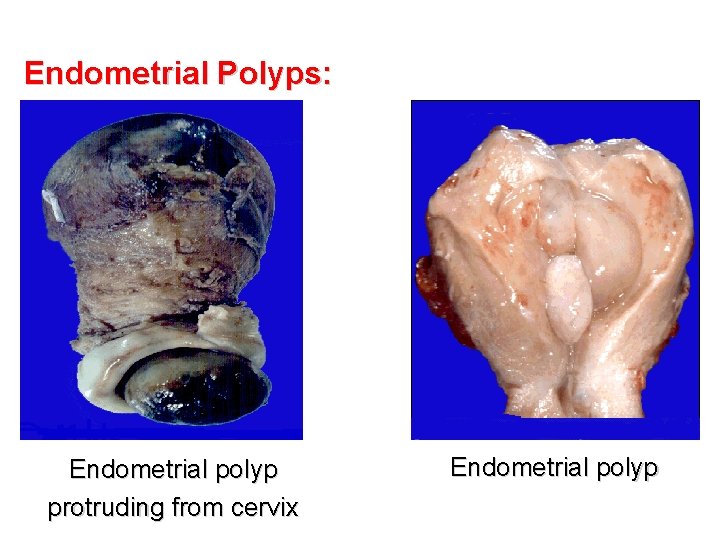 Endometrial Polyps: Endometrial polyp protruding from cervix Endometrial polyp 