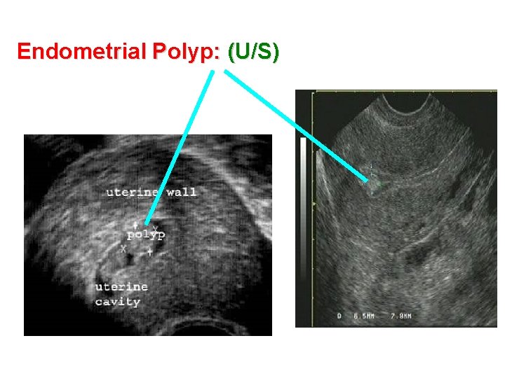 Endometrial Polyp: (U/S) 