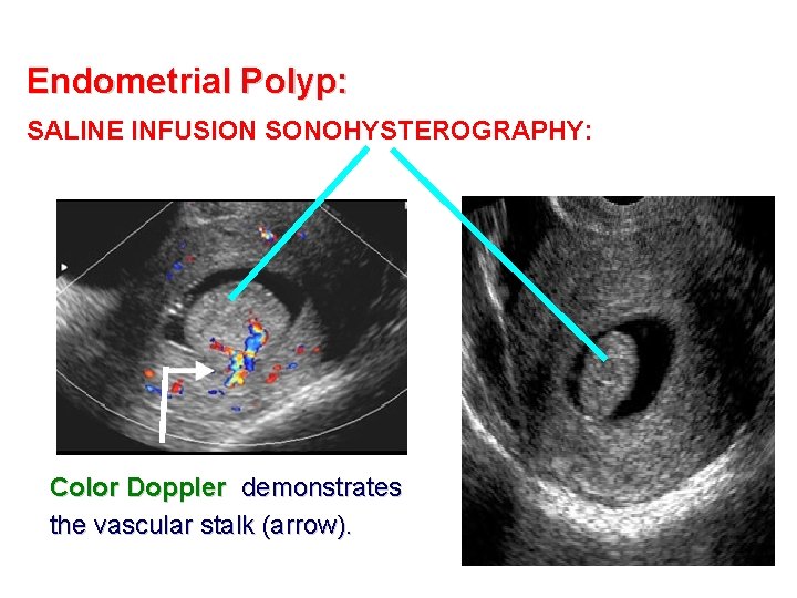 Endometrial Polyp: SALINE INFUSION SONOHYSTEROGRAPHY: Color Doppler demonstrates the vascular stalk (arrow). 