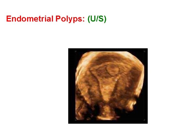 Endometrial Polyps: (U/S) 