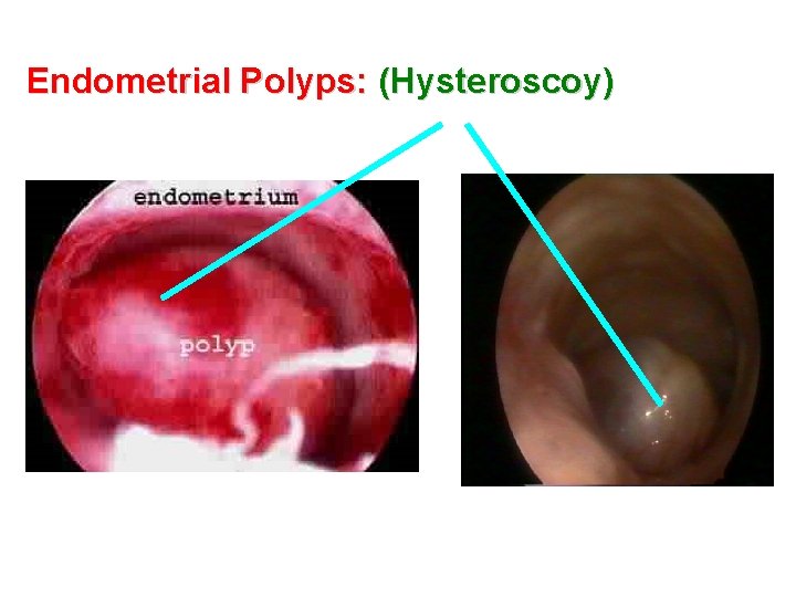 Endometrial Polyps: (Hysteroscoy) 