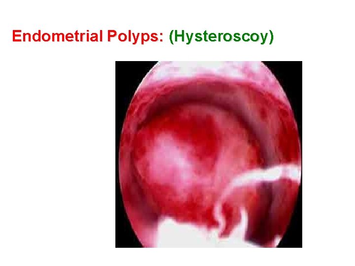 Endometrial Polyps: (Hysteroscoy) 