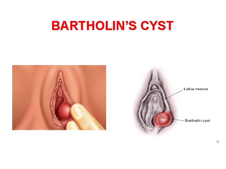 BARTHOLIN’S CYST 