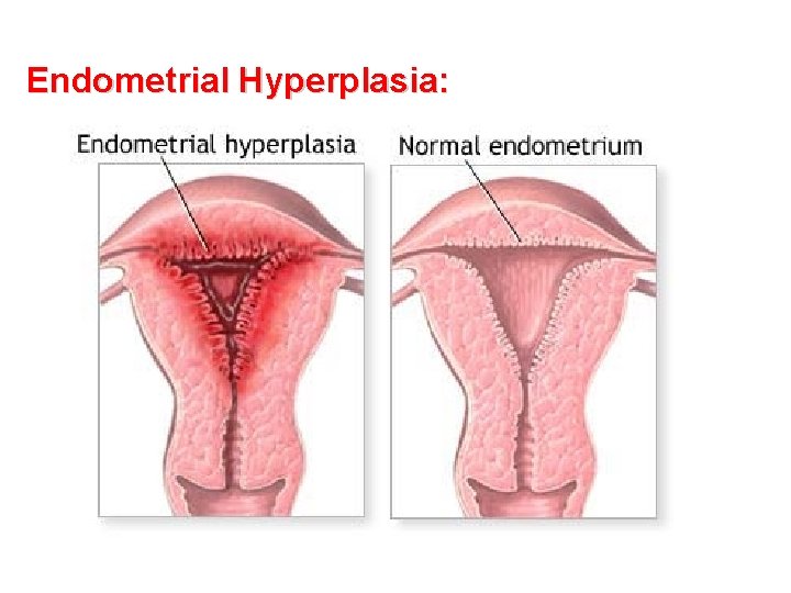 Endometrial Hyperplasia: 