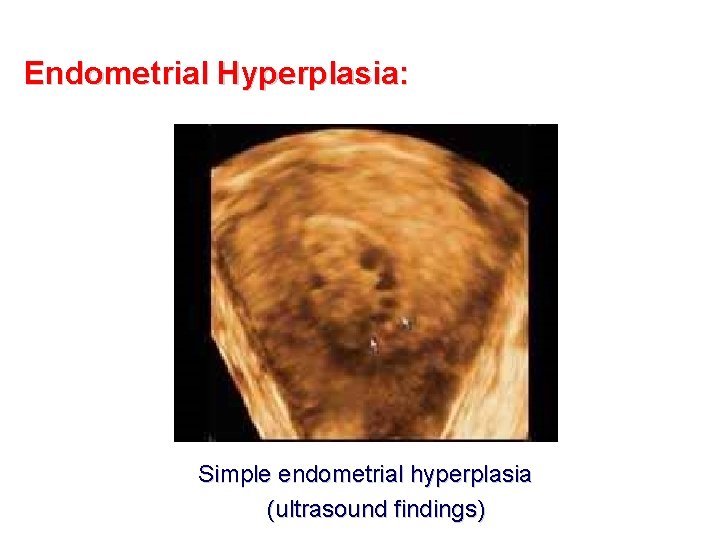 Endometrial Hyperplasia: Simple endometrial hyperplasia (ultrasound findings) 