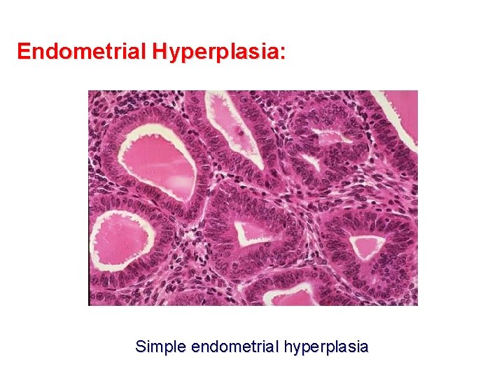 Endometrial Hyperplasia: Simple endometrial hyperplasia 