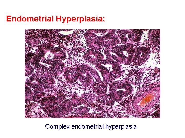Endometrial Hyperplasia: Complex endometrial hyperplasia 